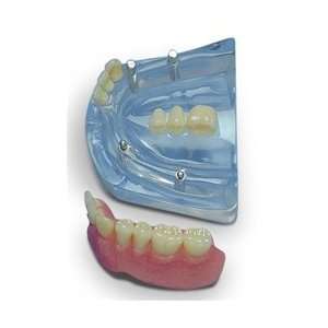  Lower combination implant model  Half overdenture and 3 